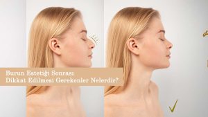 Burun Estetiği Sonrası Dikkat Edilmesi Gerekenler Nelerdir?