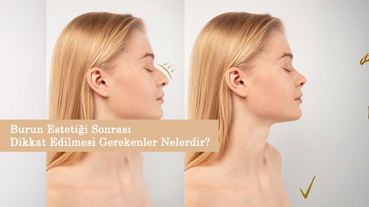 Burun Estetiği Sonrası Dikkat Edilmesi Gerekenler Nelerdir?